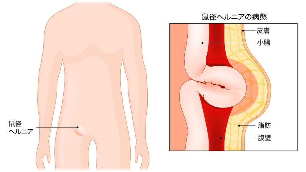 鼠径ヘルニアの病態