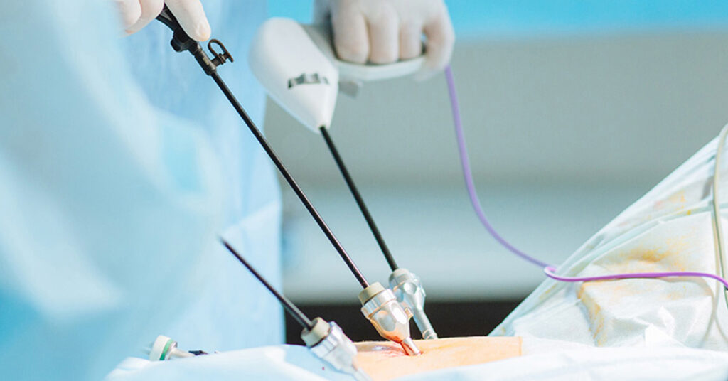 傷が小さく痛みが少ない内視鏡日帰り手術